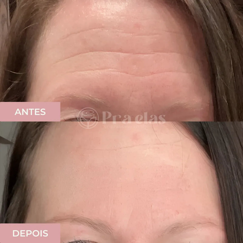 Creme Antirrugas Instantâneo - Recupere a tua Confiança